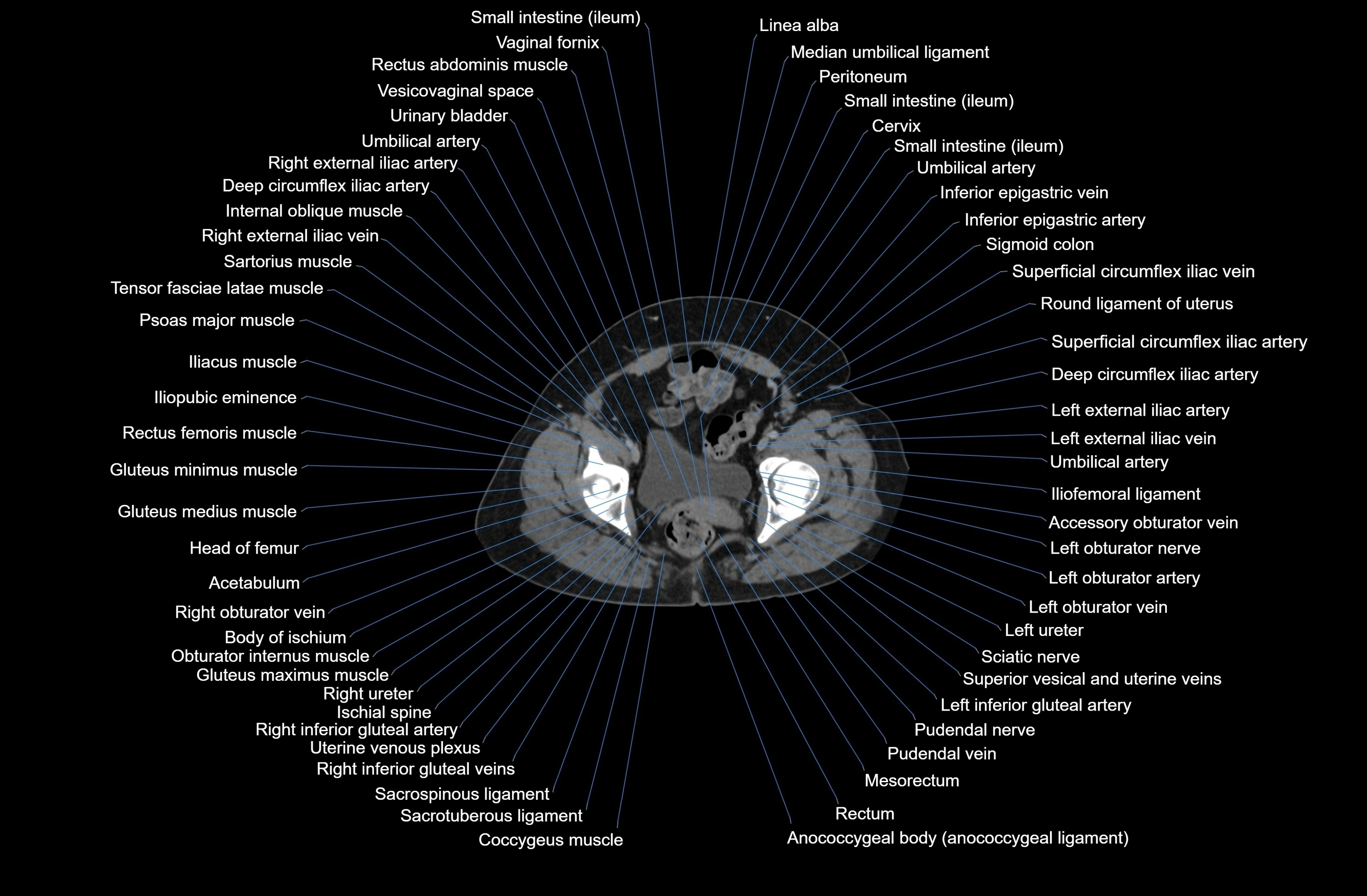 CT Abdomen axial cross sectional anatomy labelled radiology image-00089.webp